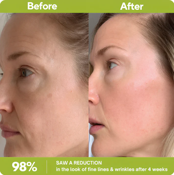 Korean Retinal Tightening Booster